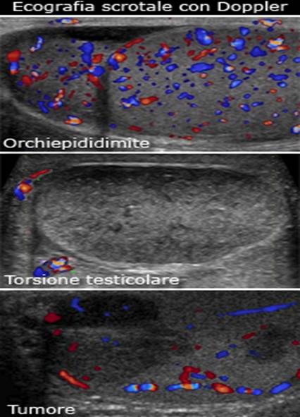 ecografia nel dolore testicolare