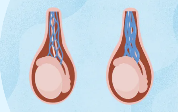 varicocele