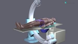 litotrissia extracorporea