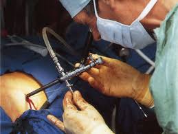 Nefrolitotomia percutanea (PCNL)