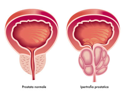Come mantenere la prostata in forma