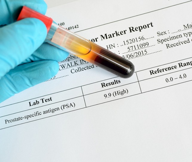PSA 1 e cancro della prostata
