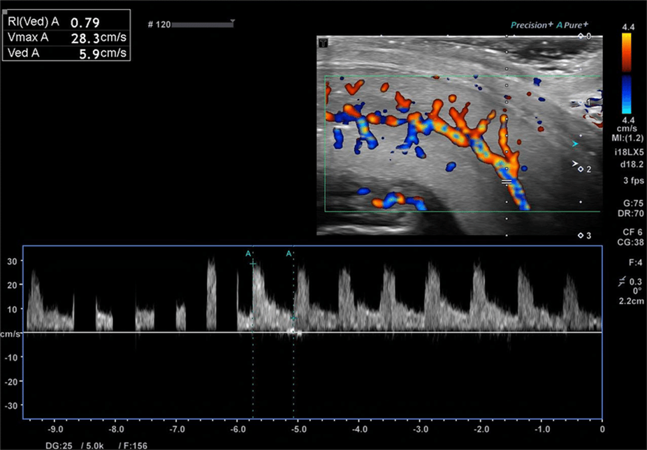 penile doppler ultrasound in impotence diagnosis