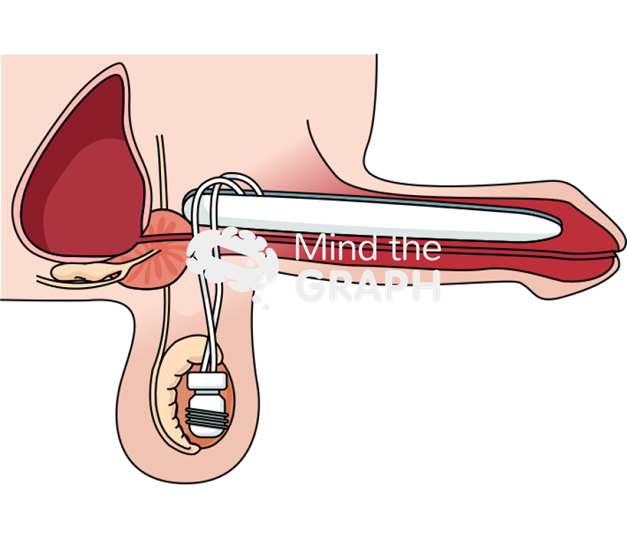 penile prosthesis in erectile impotence